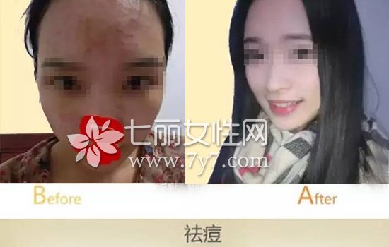 果酸换肤有什么效果