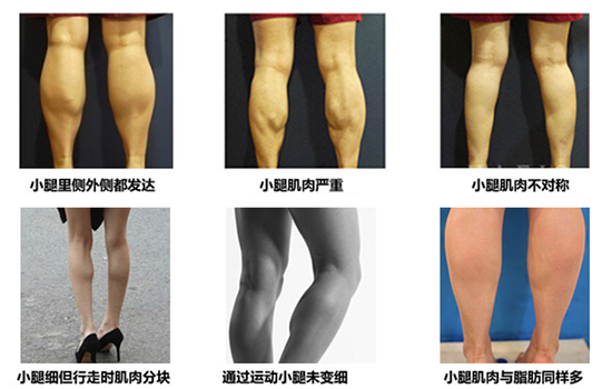 瘦腿针有效果吗 肌肉型小腿的救星就是它