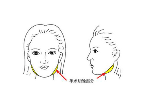 脸宽骨骼大怎么办 瘦脸前先辨清脸型