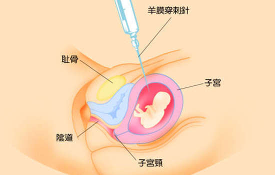 羊水穿刺多少钱 价格偏贵各不相同
