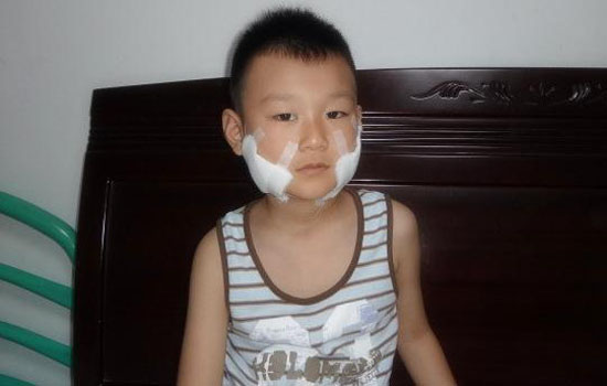 腮腺炎是怎么引起的 春季得小心腮腺炎