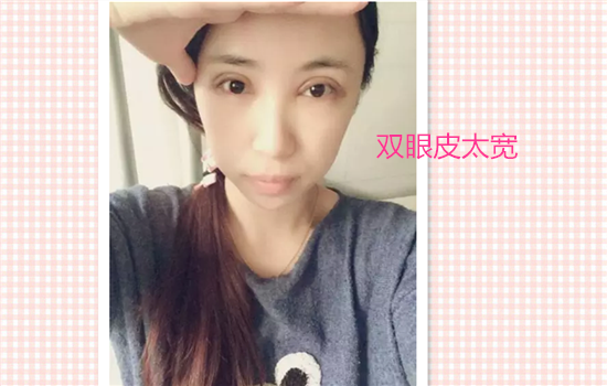 割双眼皮失败案例图片 看完你还敢割双眼皮吗