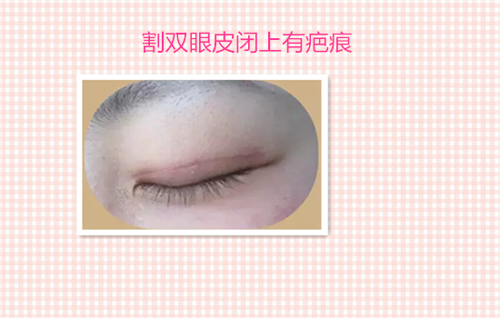 割双眼皮有什么后遗症吗 见识了6种危害你还敢不敢割