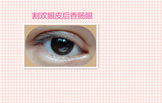 割双眼皮有什么后遗症吗 见识了6种危害你还敢不敢割