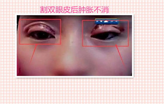 割双眼皮失败案例图片 看完你还敢割双眼皮吗