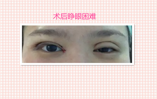 割双眼皮有什么后遗症吗 见识了6种危害你还敢不敢割