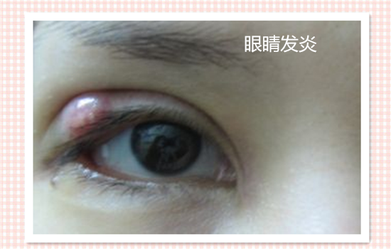割双眼皮有什么后遗症吗 见识了6种危害你还敢不敢割