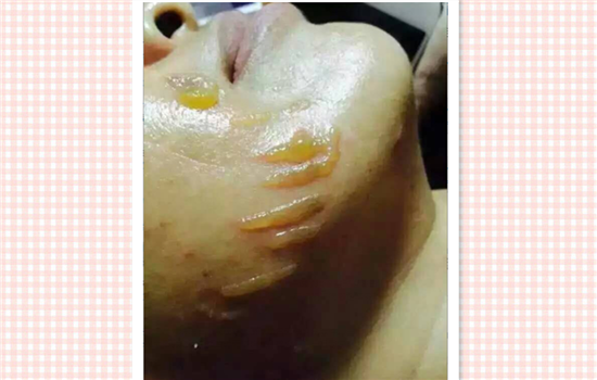 超声刀美容失败图片 超声刀让我毁容的真实例子