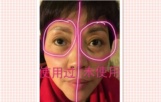 超声刀去皱纹效果怎么样 去皱纹保持时间与个人保养很有关系