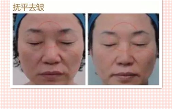 超声刀前后对比照片 6个真人经历告诉你超声刀有什么效果