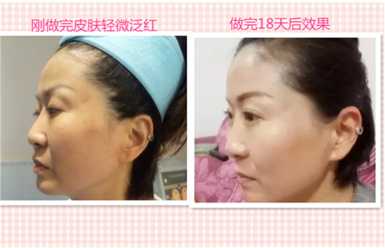 超声刀能去除法令纹吗 有效果但性价比太低