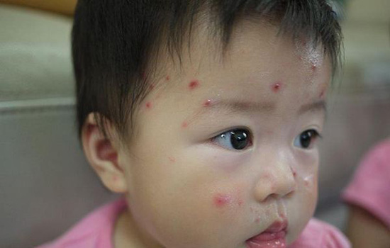水痘疤痕怎么消除 10招教你恢复完美肌肤