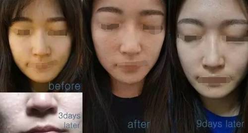 面膜和水光针那个好   详细比较让你明确自己的选择