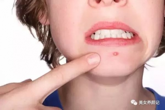 痘痘有几种类型 对症下药才能有效治痘