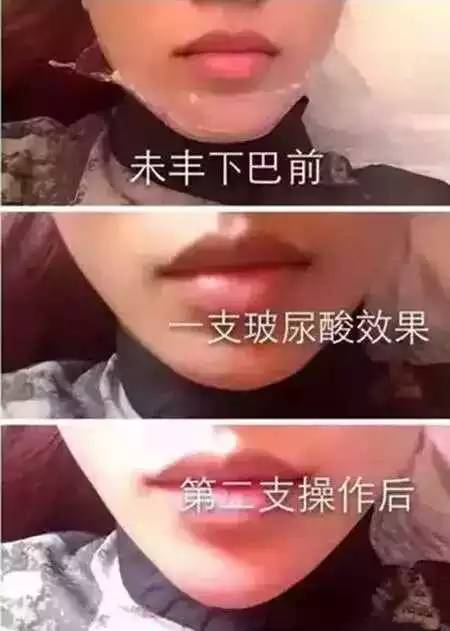 玻尿酸注射后注意事项 一支玻尿酸与两支的区别