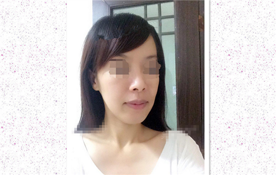 热玛吉案例 真人案例告诉你做热玛吉感受如何