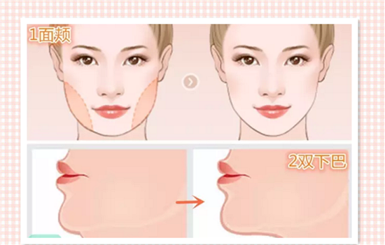 面部吸脂需要全麻吗 面部抽脂通常为局部麻醉