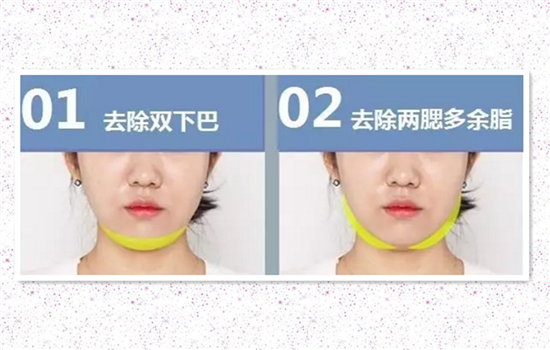 脸部可以抽脂吗 脸部要抽脂千万要注意这些