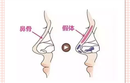 ​膨体隆鼻多久定型 手术完3个月后定型要注意那些问题