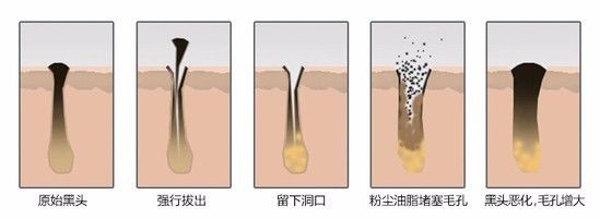 去黑头的最好方法 祛黑头的方法大全