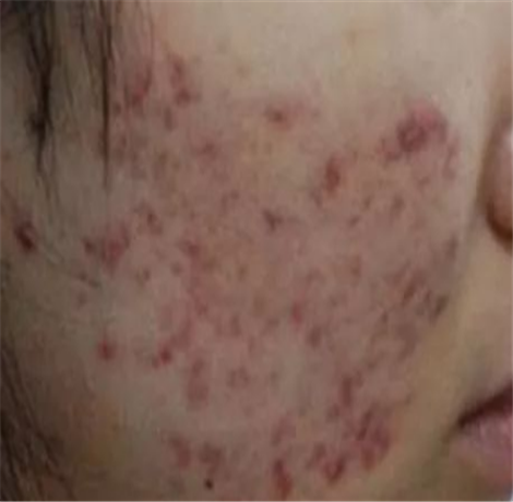 脸上红色痘印怎么消 五种消除红色痘印方法