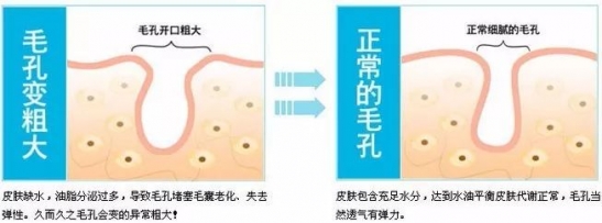 怎么解决毛孔粗大的问题  怎么缩小毛孔