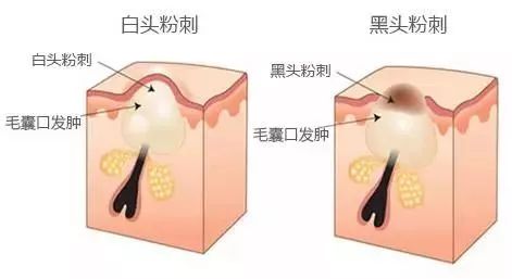脸上的闭口怎么处理 注意这几点还你天然好肌肤