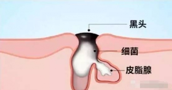 怎么解决毛孔粗大的问题  怎么缩小毛孔