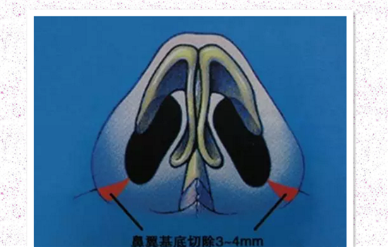 鼻翼外切有疤痕怎么办 这篇疤痕祛除攻略告诉你