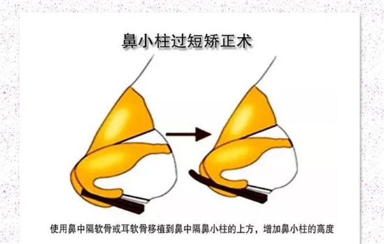 鼻小柱延长用什么材料 可优先选择鼻中隔软骨