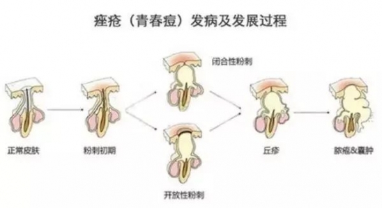痤疮青春痘会传染吗 痤疮青春痘病因分析
