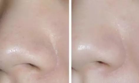 去黑头的最好方法  让颜值天敌黑头消失无踪的利器