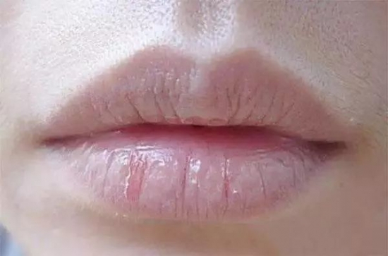 护唇小妙招 怎么正确有效的护唇吗