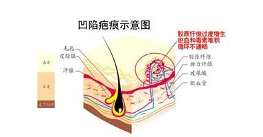 疤痕膏真的有用吗 疤痕膏祛疤原理分析