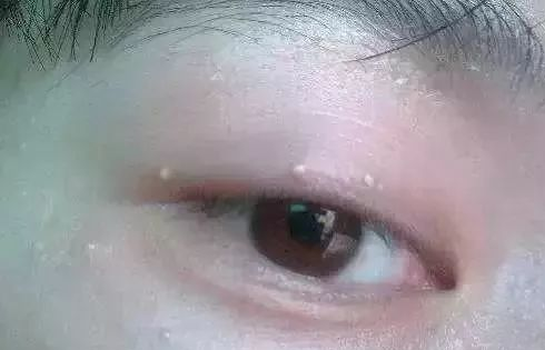 脂肪粒是怎么形成的 脂肪粒形成原因及去除方法