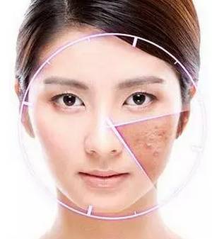 激素脸怎么补水 解决激素脸干燥的方法