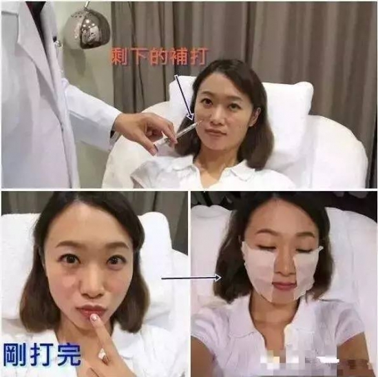法令纹怎么消除    脸上有如此显老的法令纹该怎么办呢