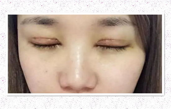 全切双眼皮加开眼角多久恢复 达人亲历有图有真相