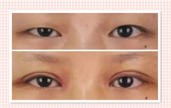 眼睑下垂会自己好吗 能自愈的话还要手术有何用