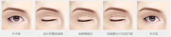 双眼皮手术恢复过程 割双眼皮，为什么你恢复的比别人慢？