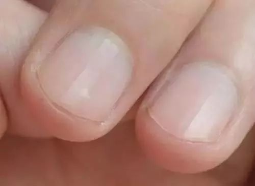 指甲出现斑点怎么回事 这些指甲斑点预示着的发生