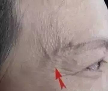 身体青筋明显咋回事 这个部位青筋暴突要注意