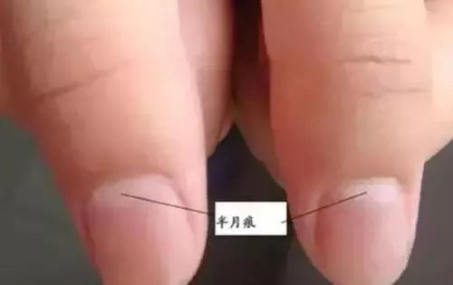 指甲出现斑点怎么回事 这些指甲斑点预示着的发生