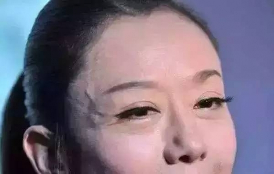 身体青筋明显咋回事 这个部位青筋暴突要注意