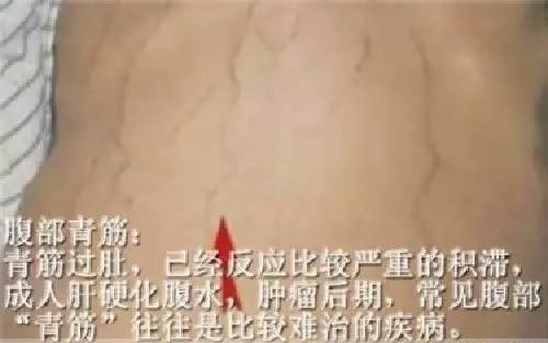 身体青筋明显咋回事 这个部位青筋暴突要注意