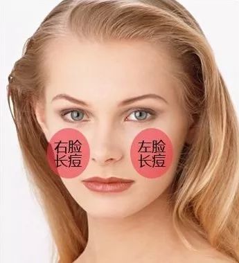 鼻子上的痘痘怎么去掉 不同部位，祛痘方法大不同！