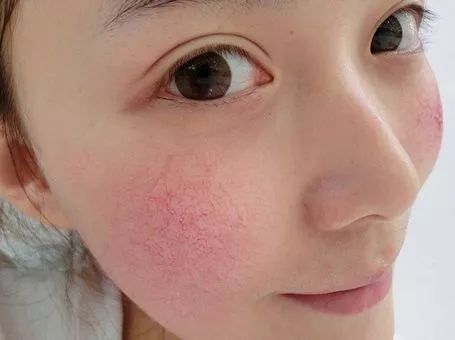 皮肤缺水会导致什么 缺水导致肌肤问题分析