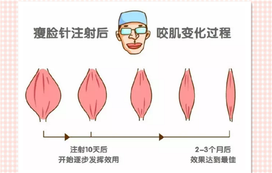 瘦脸针没效果多久补 瘦脸针没效果的6大原因你要知道