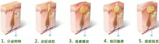 引发痤疮的原因是什么 痤疮的表现又有哪些