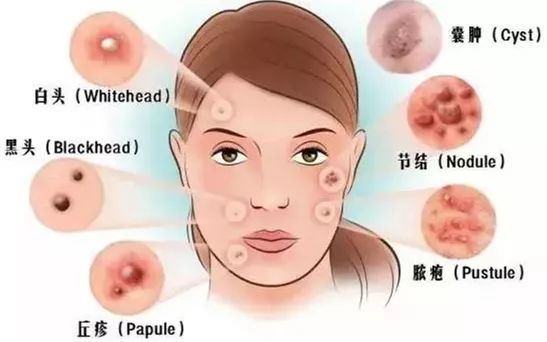 引发痤疮的原因是什么 痤疮的表现又有哪些